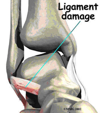 Ankle Sprains in the Athlete: Diagnosis and Treatment