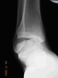 Ankle Sprains in the Athlete: Diagnosis and Treatment