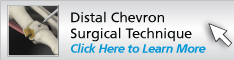 Distal Chevron Technique