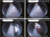 Endoscopic Plantar Fasciotomy for Heel Pain