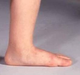 Pediatric Flatfoot