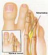 New Surgical Treatment for Neuroma