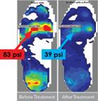 Improve Foot Function, Reduce Pain and Increase Mobility with Pressure Mapping