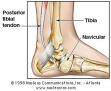 Tendonitis