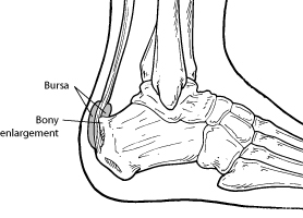 Haglund's Deformity 